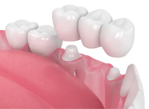 Dental Crowns & Bridges